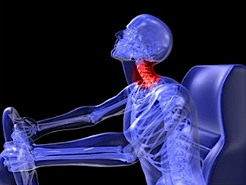 Car accident resulting in Whiplash