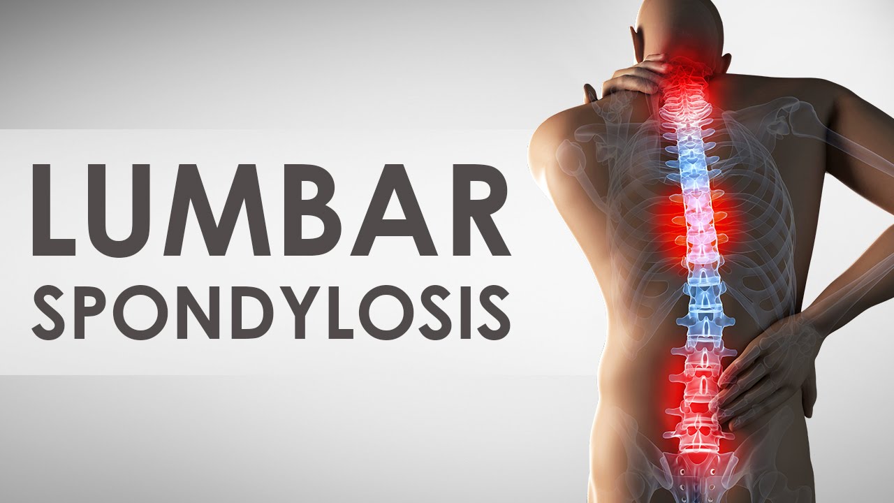 Lumbar Spondylosis
